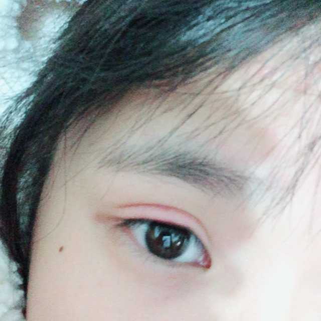 这是去年眼睛过敏的时候 肿的可怕