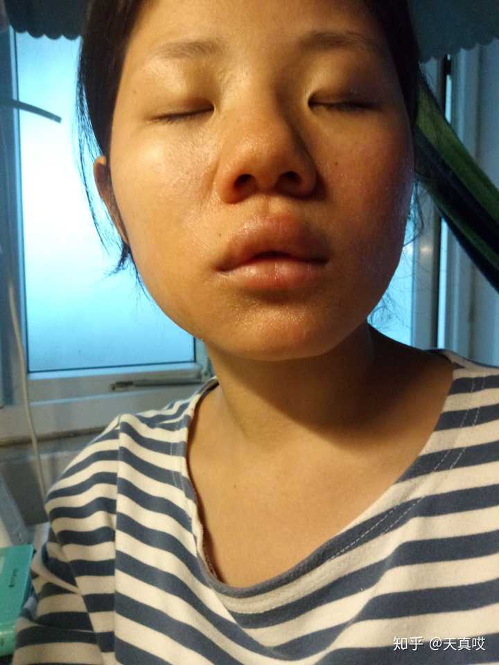 芒果过敏是一种怎样的感觉?