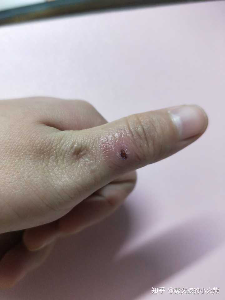 刺猴老是反反复复 求各位大神解答?
