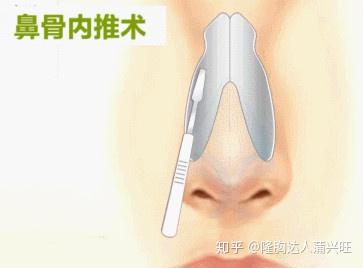 鼻骨内推手术的目的就是让宽大的鼻骨进行缩窄,缩窄到与五官相协调的