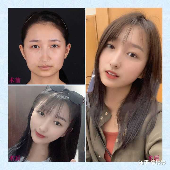 整形削骨有后遗症吗?