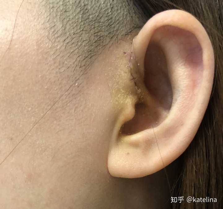 右边结痂中,待续.