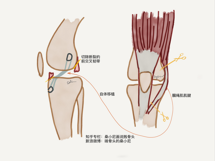 按下葫芦浮起瓢"——重建前交叉韧带的同时,又造成了大腿肌腱新的损伤
