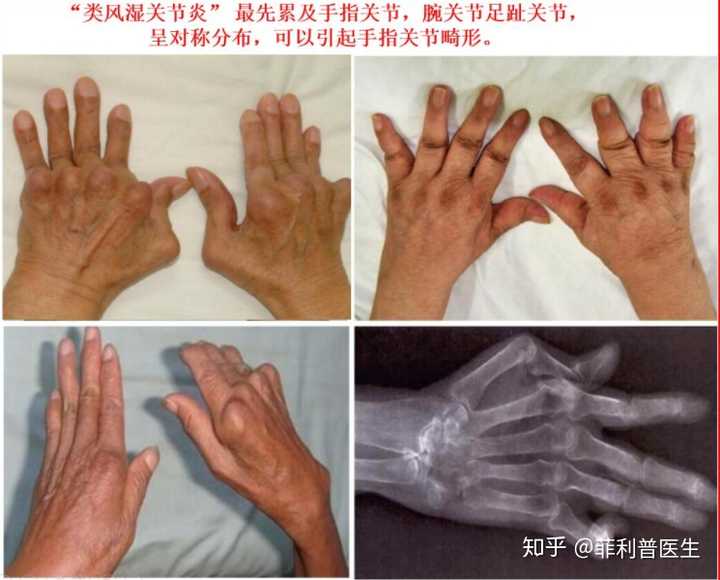 类风湿关节炎引起的双手关节畸形和残疾