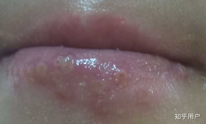 嘴唇可能长疱疹了以后肿了怎么办?