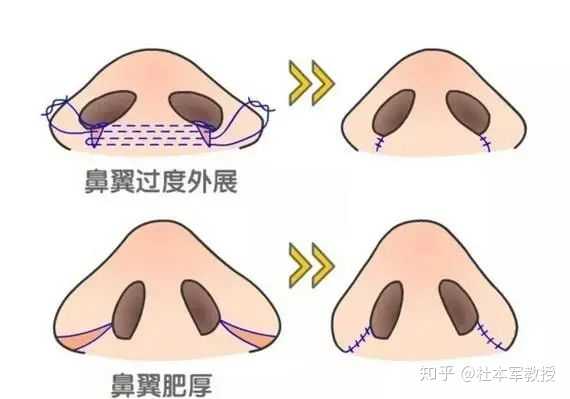 鼻翼缩小手术是种怎样的体验?