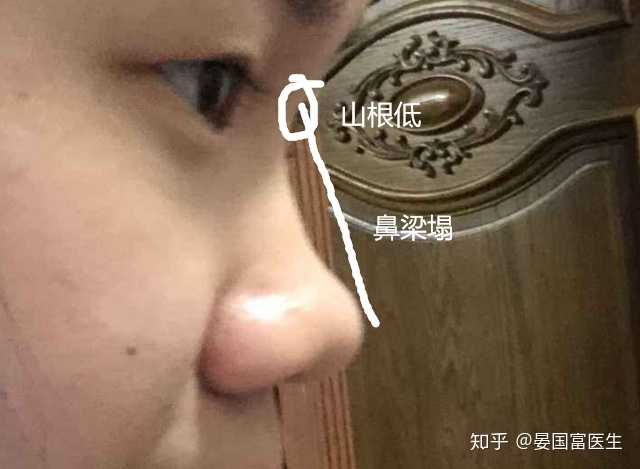 这样属于山根低还是鼻梁塌?