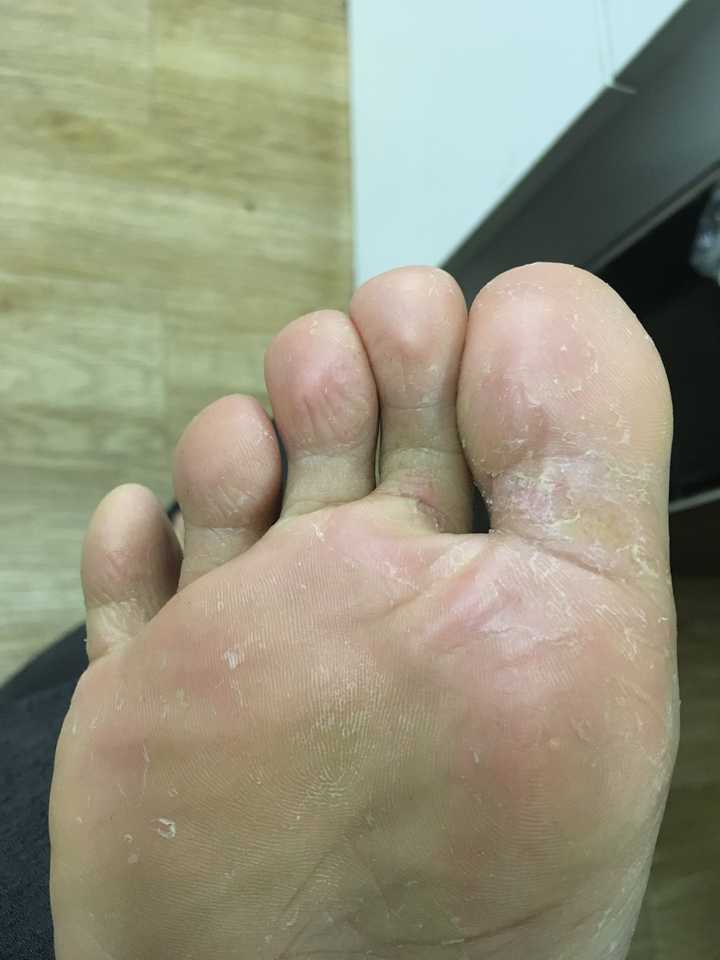 脚上老长水泡,脱皮,据说是真菌感染,请问有什么办法根治吗?