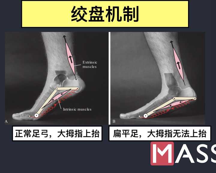 小腿粗和走路姿势有关系吗?