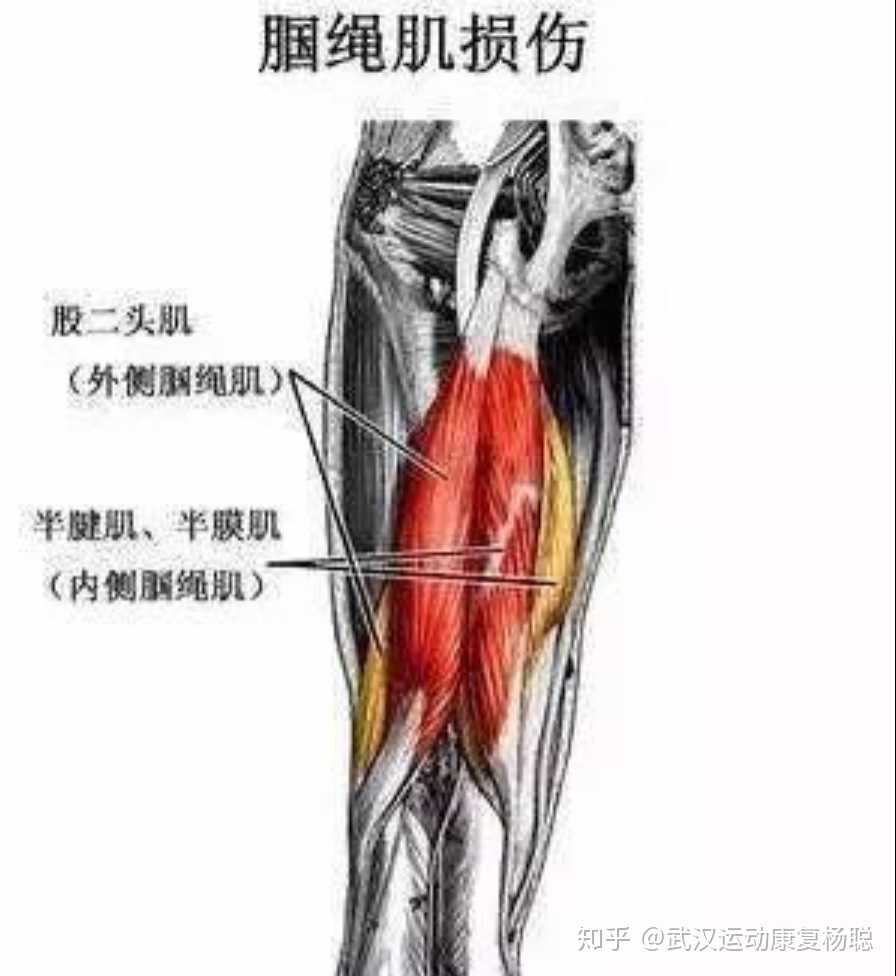 武汉运动康复杨聪 的想法 腘绳肌肌腱炎或腘绳肌拉伤 症状 1.