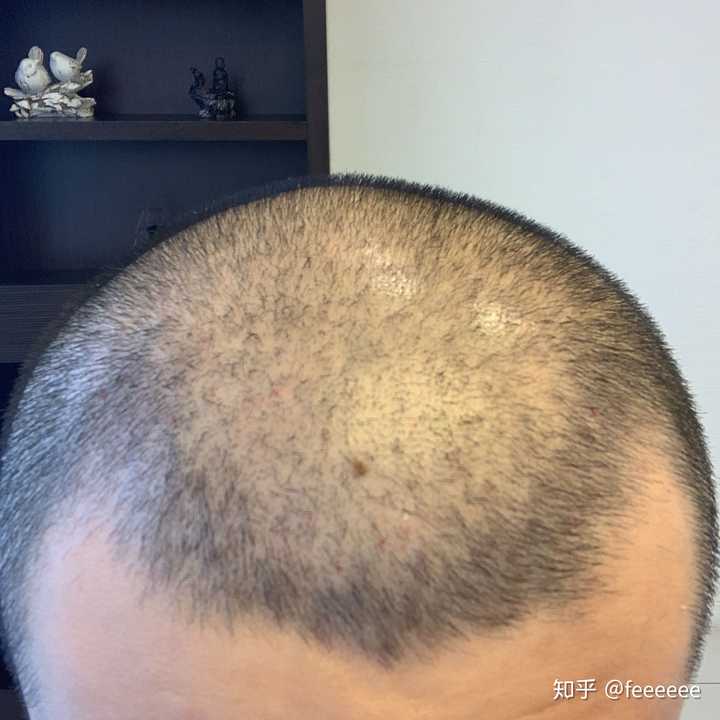 脱发,剃个光头需要多大勇气?