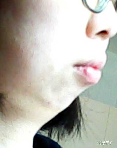 下巴后缩是种怎样的体验?