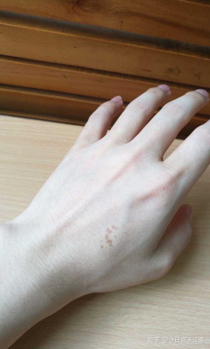 莫名的拍了下手背,没有拍伤口. 记得是一条红红的,可以撕那些死皮了!