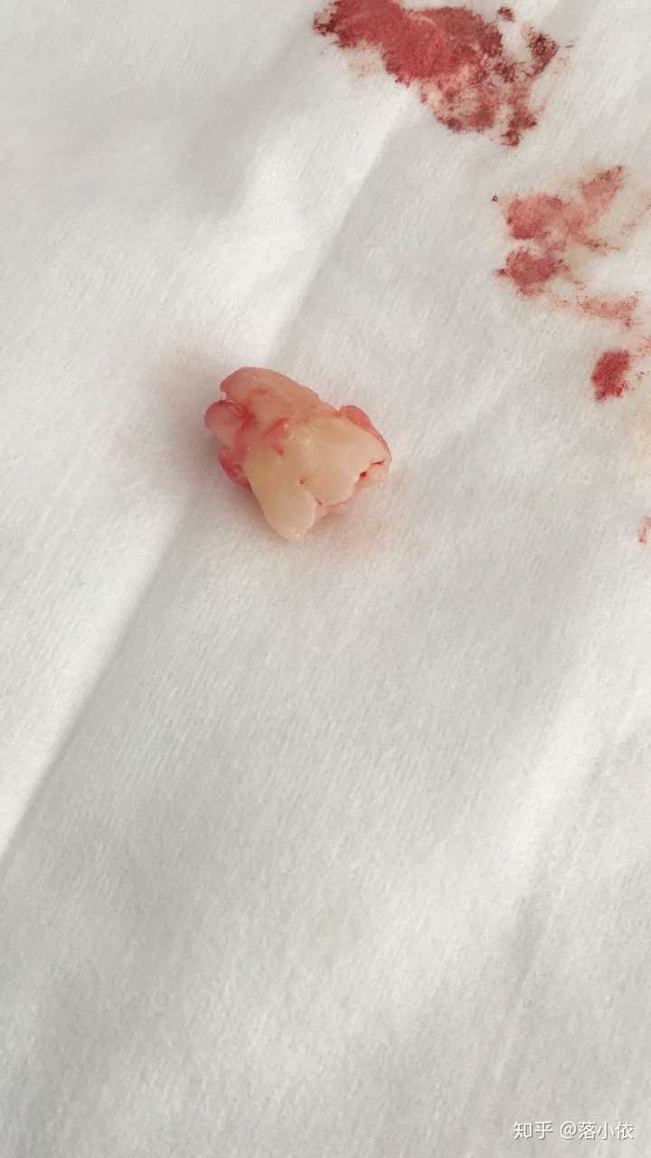 今年2月15号拔掉了第一颗智齿 只是露出了一个小角,为了以绝后患,果断