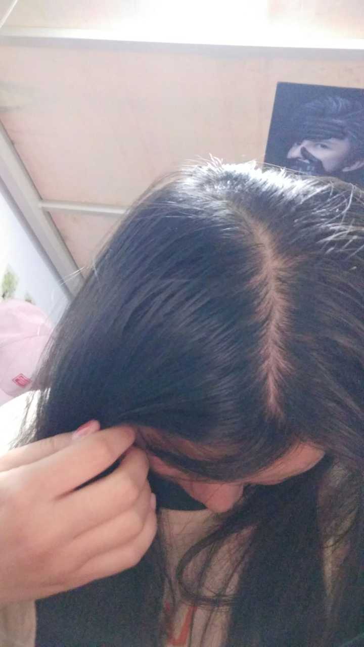 女性脂溢性脱发,有没有治愈的?