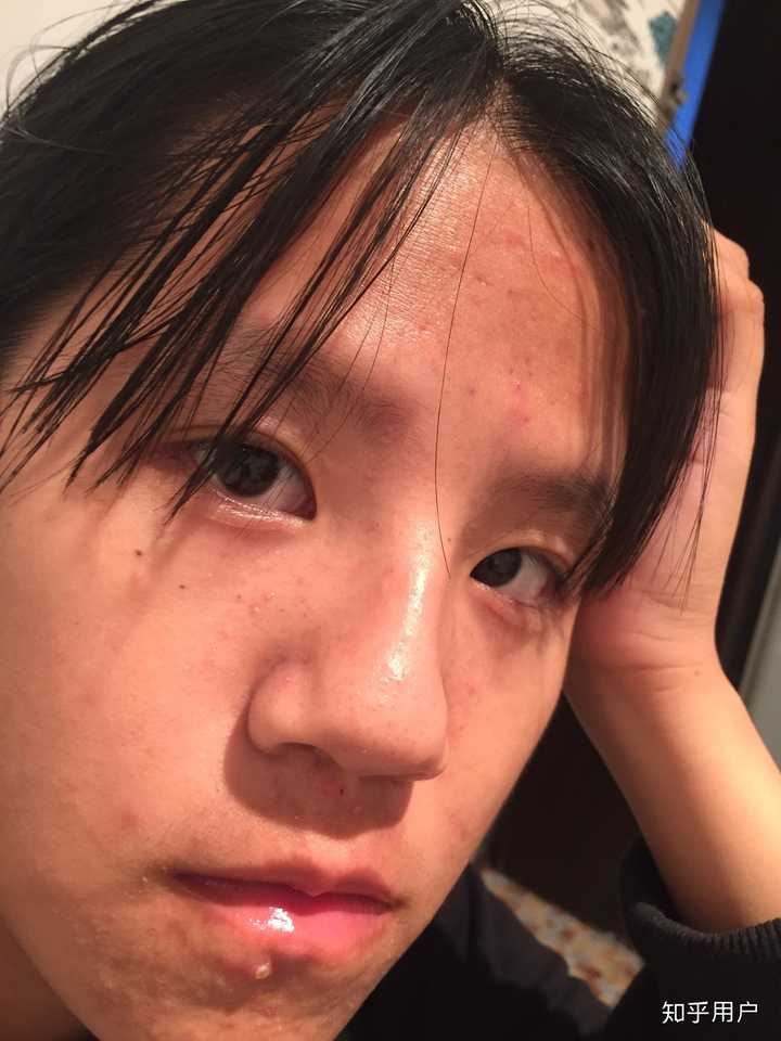 这张后置下怼脸拍的 光线也拯救不了我的憔悴  作业一多就长痘 我太难