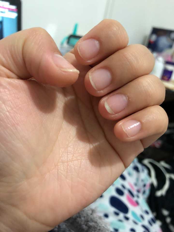 手指甲被咬的超级短怎么办?