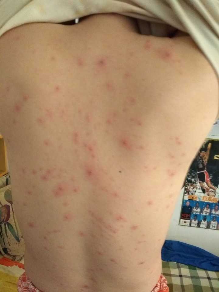长水痘是一种怎么样的体验?