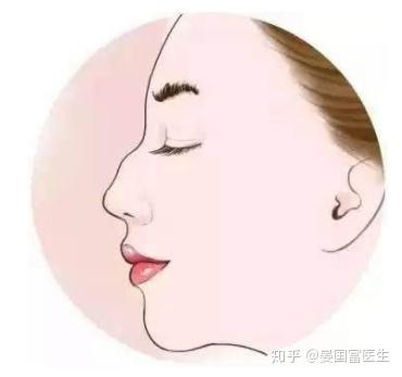临床表现为鼻背中间部位高于鼻根与鼻尖,向外钩,侧面看线条不够流畅