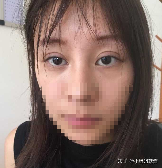 割双眼皮是种怎样的体验