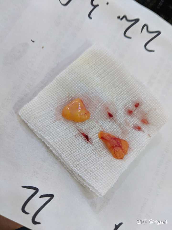 对于肉眼泡来说,做眼部抽脂安全么?