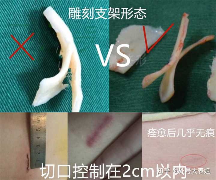 2.肋软骨的雕刻支架决定稳定性