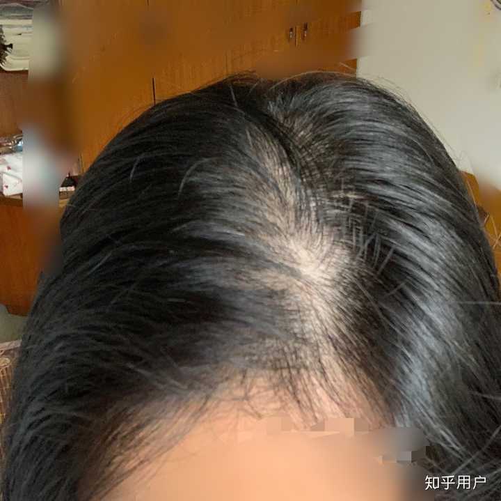 女生秃顶是怎样一种体验?