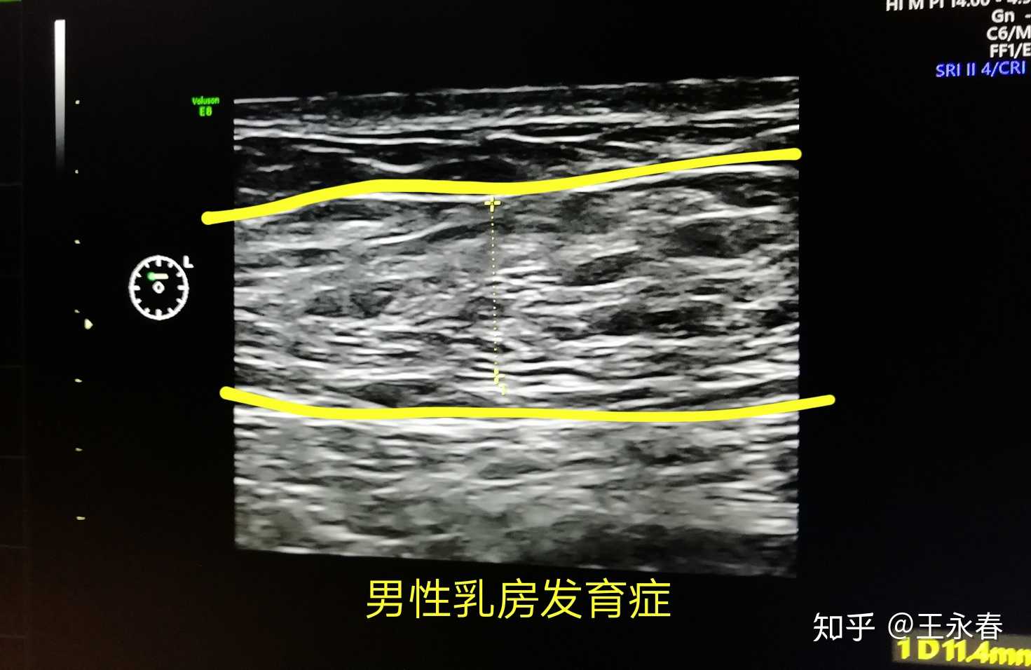 男性乳房发育症