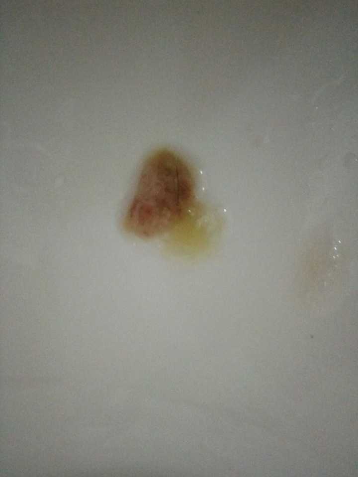 5以上,咳血痰(不要被图片恶心到)连烧了两天打点滴加吃药,现在扁桃体