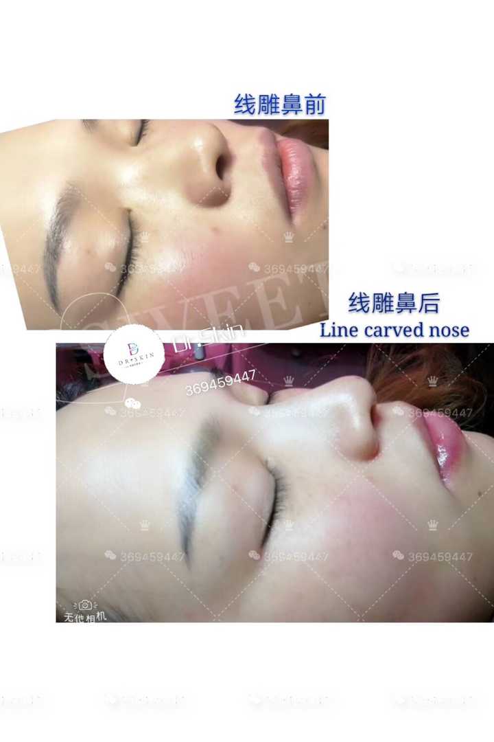 线雕隆鼻是怎么个原理,有什么危害吗?