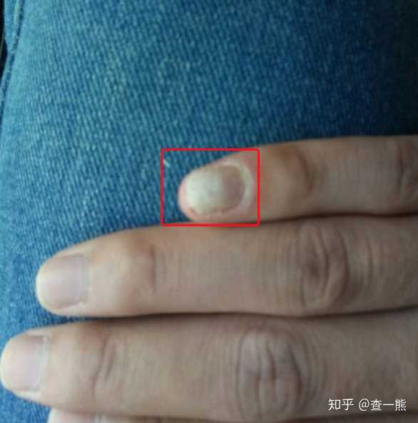 这是什么灰指甲啊,长在手上太难看了