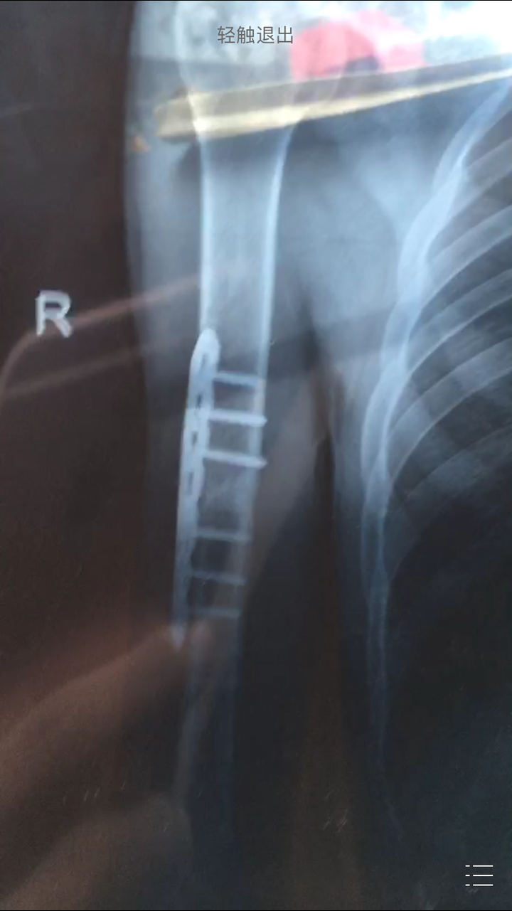 右肱骨开放性骨折已经一年了取钢板风险大吗