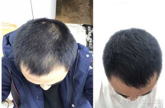 有效率:轻度脱发的有效率可达70%左右,对于中度,重度脱发,以及前额发