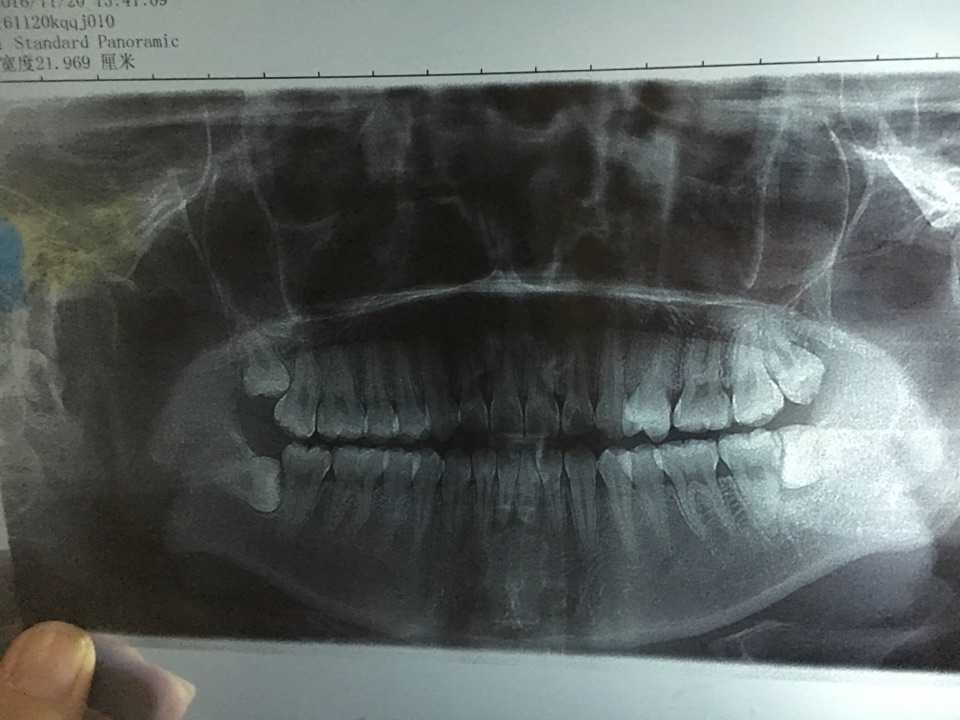 水平阻生智齿. 我长了四颗智齿,两颗水平阻生,医生跟我讲全部要拔.