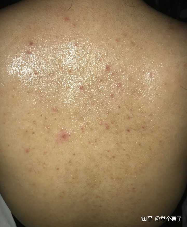 背后长痘痘要怎么办?