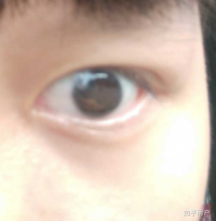 单眼失明是种怎样的体验?