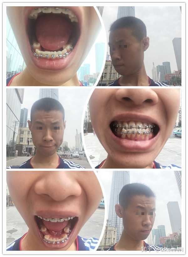 牙齿地包天(兜齿)是怎样的一种体验?