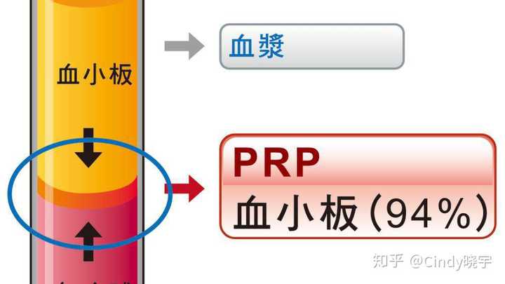 原理:抽取自身血液20-30毫升,进行高震荡分离,提取血清.