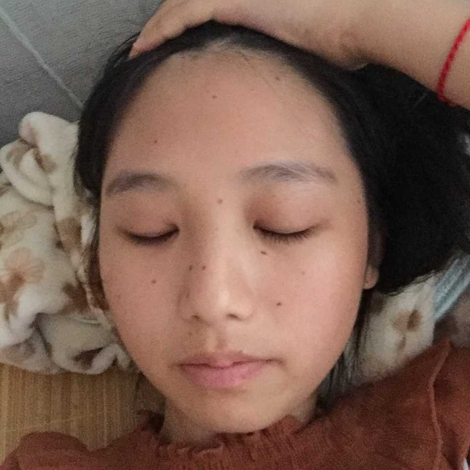 没有一点点防备,就这样点了痣!第一天自我感觉还好.
