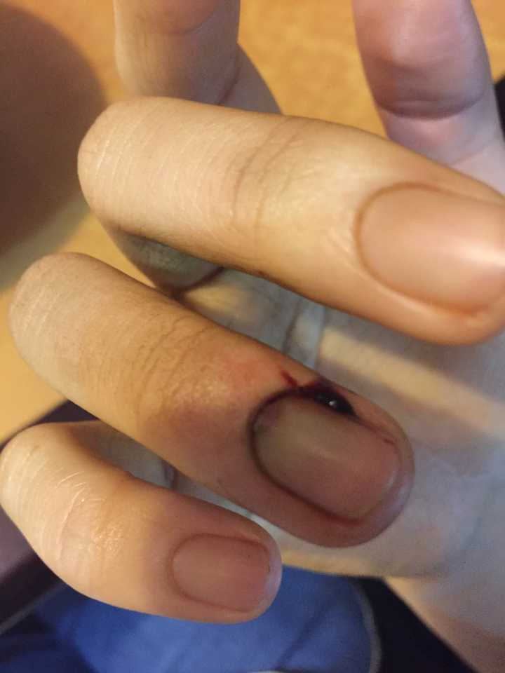手指被门夹到飙泪是种怎样的体验?
