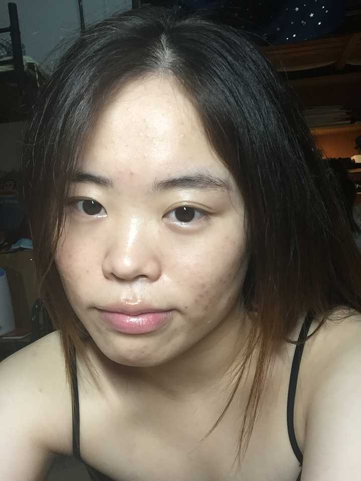 明明脸长的很精致,身材没的说,却总有冒不完的痘痘(各种痘)是一种什么