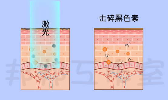痘痘消退后留下的黑色素沉淀怎么快速消退?