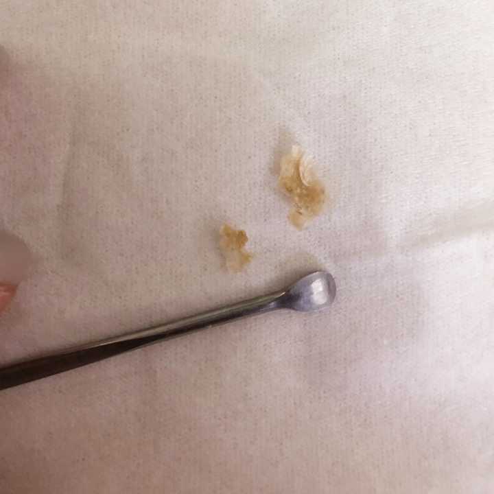 掏出一块很大的耳屎是一种的体验?