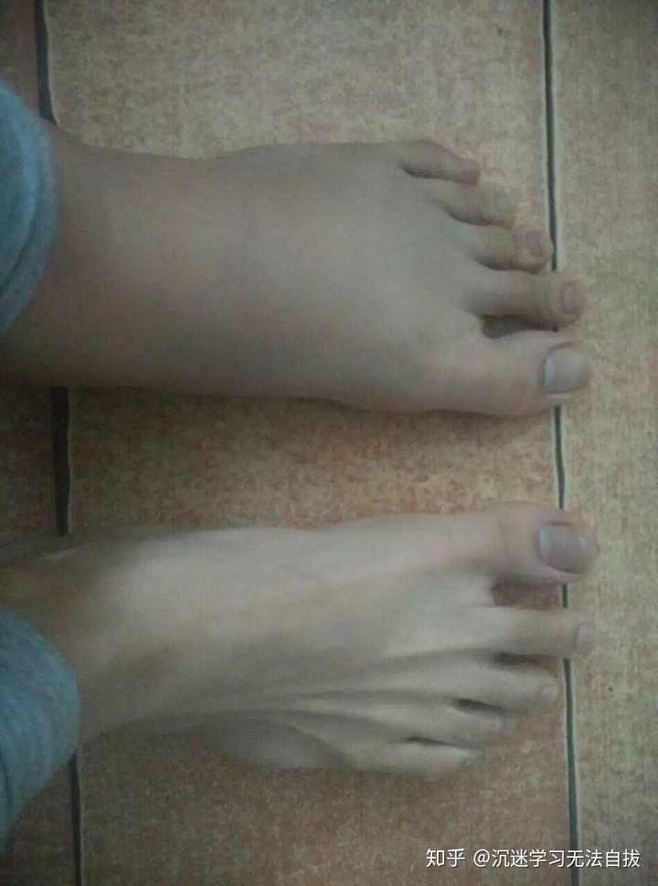 左脚脚踝的内侧崴伤