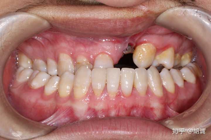 9-11岁:牙槽突裂手术,一般需要植骨.