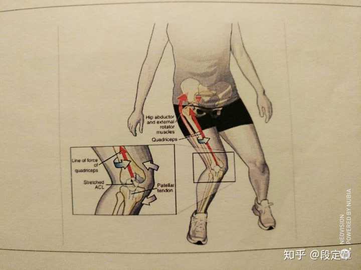 踝关节外翻,脚功塌陷,膝关节内扣 这源于一个共同的原因,臀肌失忆症.