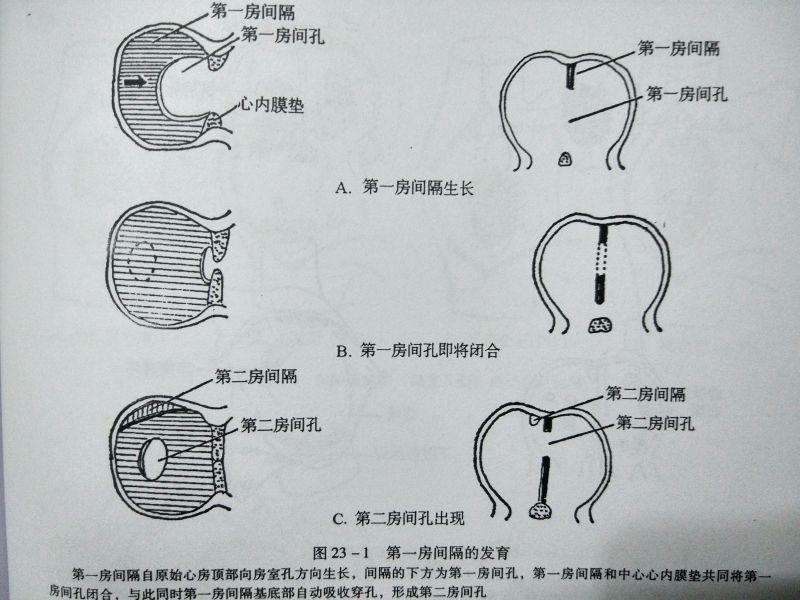 这我们就要从房间隔的发育说起来了.