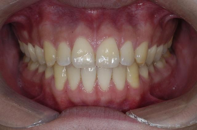 请问大家两排牙齿在口腔是怎么放的是上牙前下牙后还是上下牙对齐