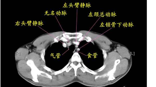 由上及下依次: 主动脉弓层面 肺部的 ct 片,医生就是这么连着看下来.