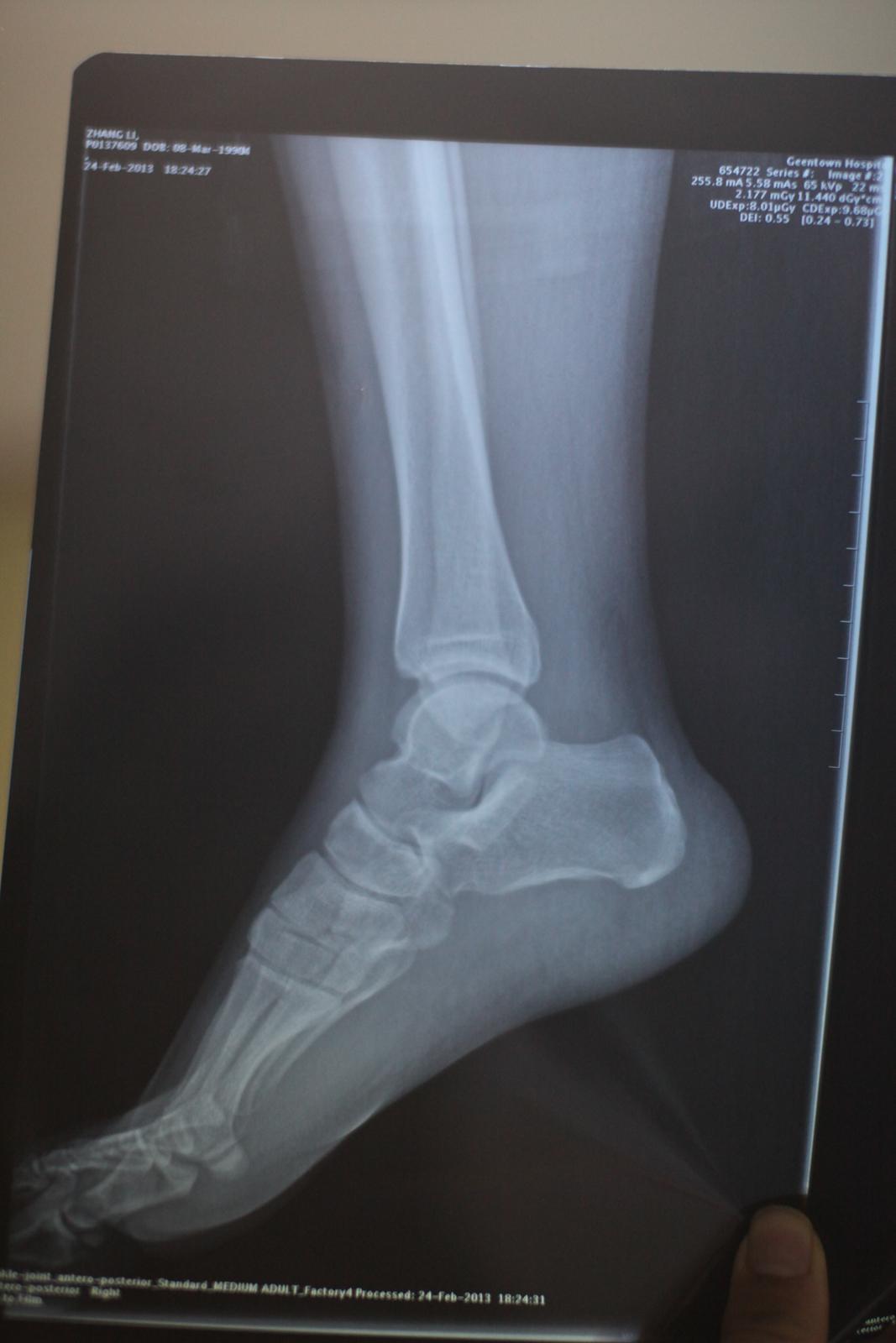 两个多星期前脚扭伤了,现在能正常走路,但是为什么这么久了还不消肿?